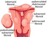 Fibroids